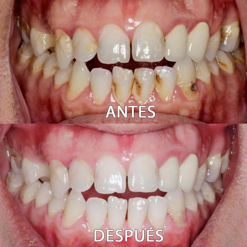Blanqueador Dental V34 - ¿Dientes amarillos y encías inflamadas? lo soluciona + Regalos Exclussivos