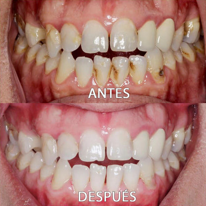 Blanqueador Dental V34 - ¿Dientes amarillos y encías inflamadas? lo soluciona + Regalos Exclussivos